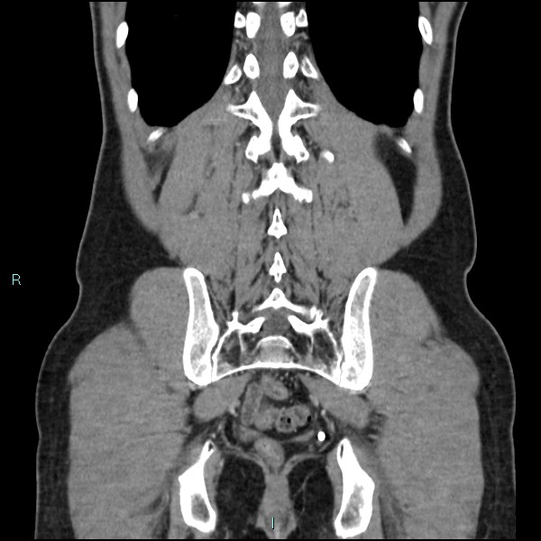 Adrenal cystic lymphangioma (Radiopaedia 83161-97534 Coronal C+ portal venous phase 61).jpg