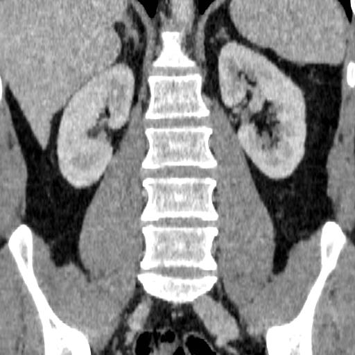 File:Adrenal glands (normal CT anatomy) (Radiopaedia 16570-105725 Coronal 12).jpg