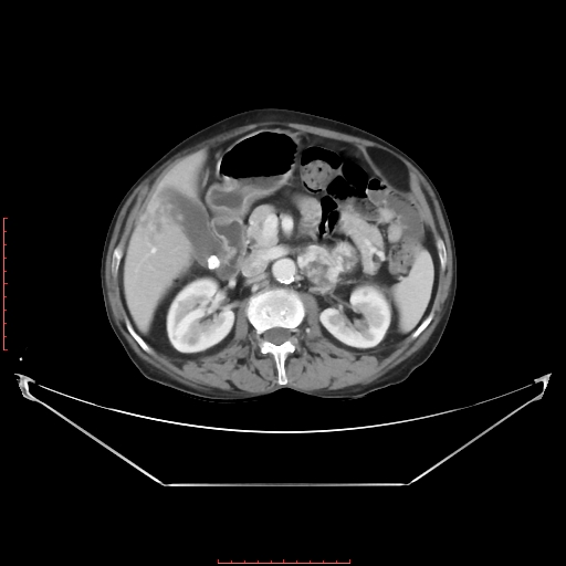 Adrenal hemangioma (Radiopaedia 68923-78668 Axial C+ portal venous phase 30).jpg