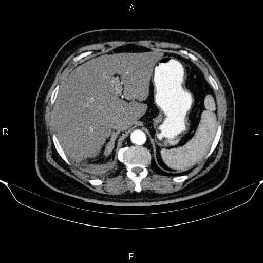 Adrenal hemorrhage (Radiopaedia 62622-70916 Axial C+ arterial phase 70).jpg
