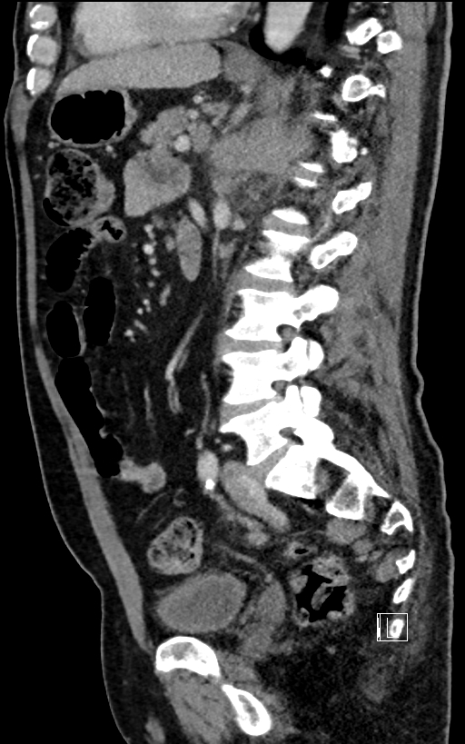 Adrenal lymphoma (Radiopaedia 73730-84529 Sagittal C+ portal venous phase 66).jpg