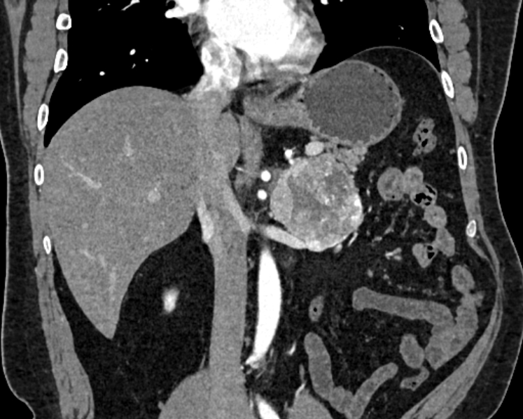 File:Adrenal metastases (Radiopaedia 73082-83791 Coronal C+ arterial phase 21).jpg
