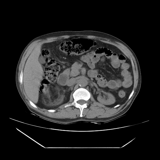 File:Adrenal myelolipoma (Radiopaedia 41843-44834 Axial non-contrast 28).jpg