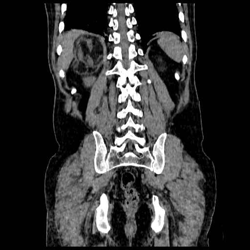 File:Adrenal myelolipoma (Radiopaedia 41843-44834 Coronal non-contrast 19).jpg