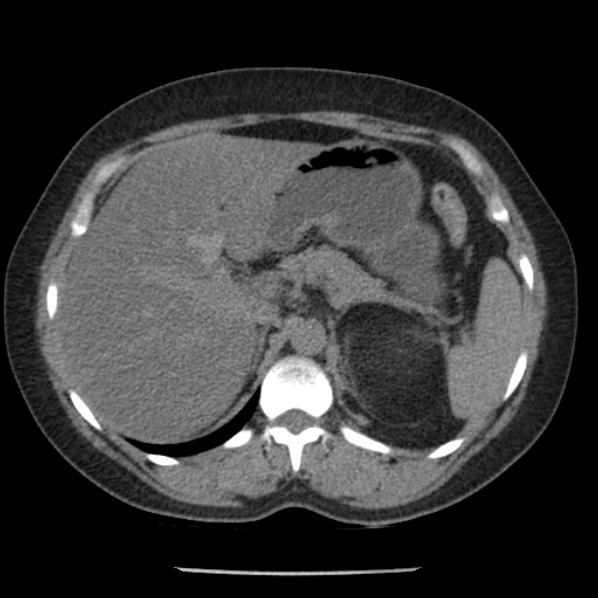 Adrenal myelolipoma (Radiopaedia 43401-46759 Axial non-contrast 23).jpg