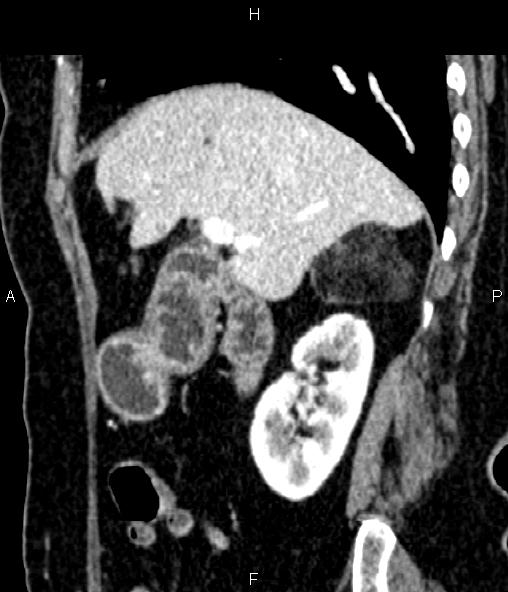 Adrenal myelolipoma (Radiopaedia 82742-96986 Sagittal renal cortical phase 39).jpg