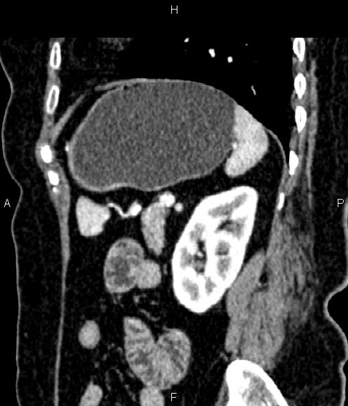File:Adrenal myelolipoma (Radiopaedia 82742-96986 Sagittal renal cortical phase 79).jpg