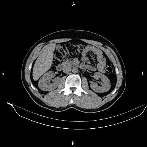 Adrenal myelolipoma (Radiopaedia 87794-104246 Axial non-contrast 45).jpg