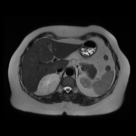 File:Adrenal myelolipoma - MRI (Radiopaedia 83249-97646 Axial T2 13).jpg
