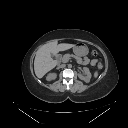 File:Adrenal myelolipoma - MRI (Radiopaedia 83249-97647 Axial non-contrast 49).jpg