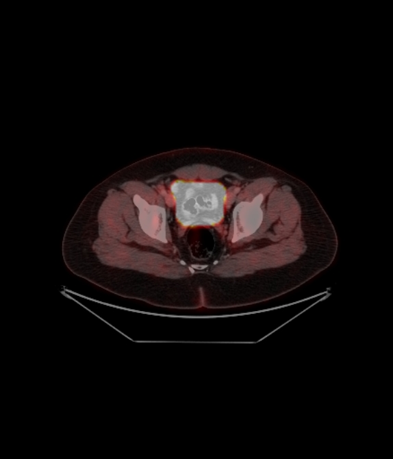 Adrenocortical carcinoma (Radiopaedia 80134-93440 ِAxial 242).jpg