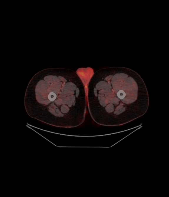 Adrenocortical carcinoma (Radiopaedia 80134-93440 ِAxial 286).jpg