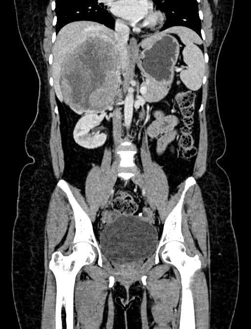 Adrenocortical carcinoma (Radiopaedia 87281-103569 Coronal C+ portal venous phase 53).jpg