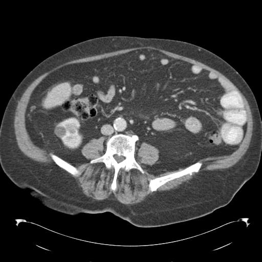 Adult ileal intussusception with secondary obstruction (Radiopaedia 30395-31051 Axial C+ portal venous phase 45).jpg