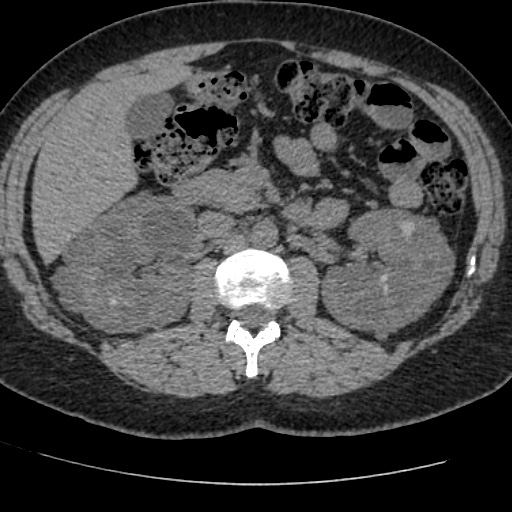 Adult polycystic kidney disease (Radiopaedia 59075-66368 Axial non-contrast 30).jpg