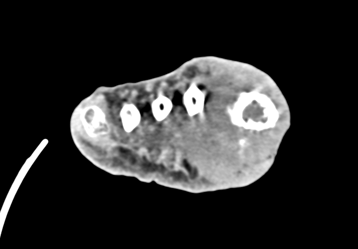 Advanced osteomyelitis due to open metatarsal fracture (Radiopaedia 83891-99095 Axial non-contrast 39).jpg