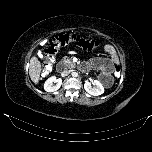 Afferent loop syndrome - secondary to incarcerated trocar site hernia (Radiopaedia 82959-97305 Axial C+ portal venous phase 92).jpg