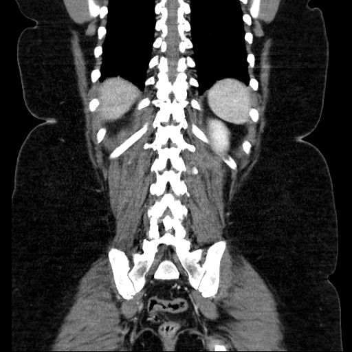 File:Afferent loop syndrome - secondary to incarcerated trocar site hernia (Radiopaedia 82959-97305 Coronal C+ portal venous phase 115).jpg