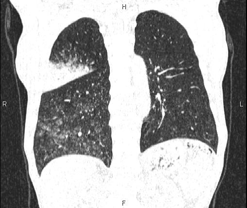 Air bronchogram in pneumonia (Radiopaedia 85719-101512 Coronal lung window 43).jpg