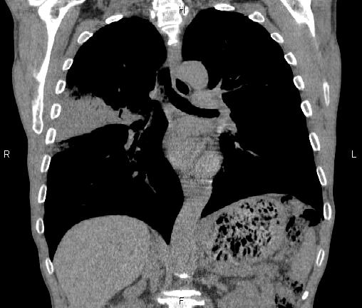 Air bronchogram in pneumonia (Radiopaedia 85719-101512 Coronal non-contrast 33).jpg