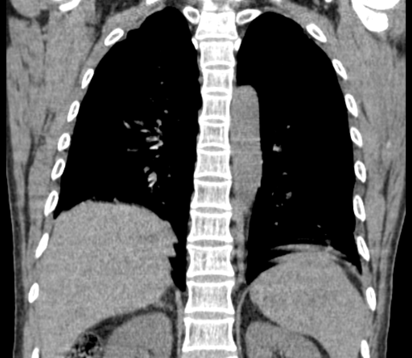 Airway foreign body in adult (Radiopaedia 85907-101779 Coronal liver window 189).jpg