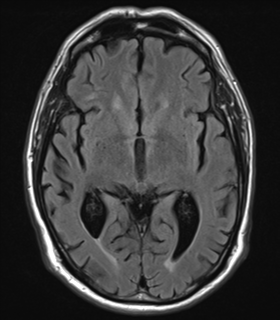 File:Alzheimer's disease- with Gerstmann syndrome and dressing apraxia (Radiopaedia 54882-61150 Axial FLAIR 13).png