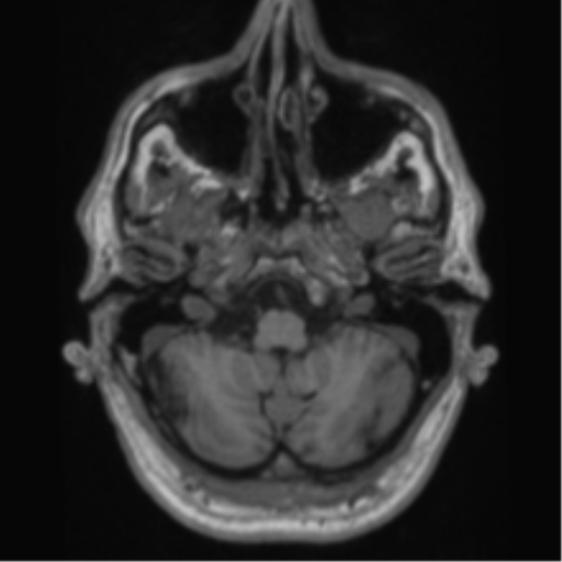 Alzheimer's disease- with Gerstmann syndrome and dressing apraxia (Radiopaedia 54882-61150 Axial T1 12).png