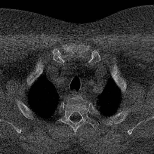 Ameloblastoma (Radiopaedia 38520-40623 Axial bone window 77).png