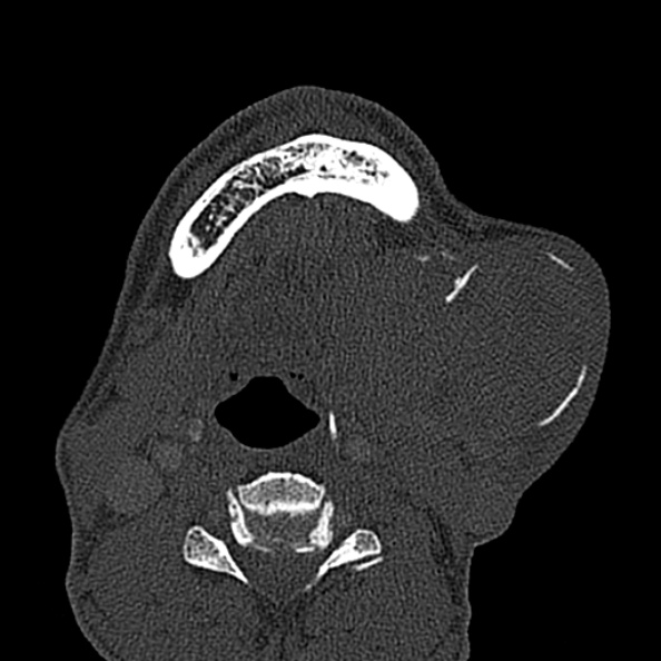 Ameloblastoma (Radiopaedia 51921-57766 Axial bone window 32).jpg