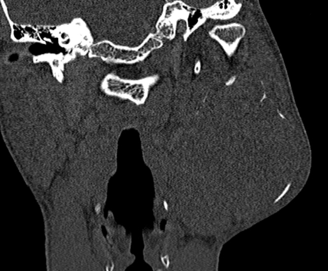 Ameloblastoma (Radiopaedia 51921-57766 Coronal bone window 194).jpg