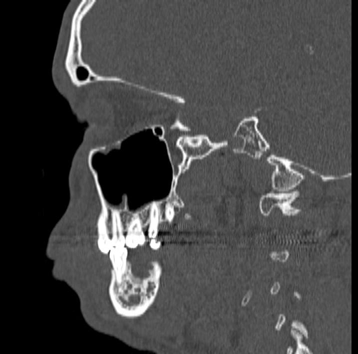 Ameloblastoma (Radiopaedia 77750-89997 Sagittal bone window 32).jpg