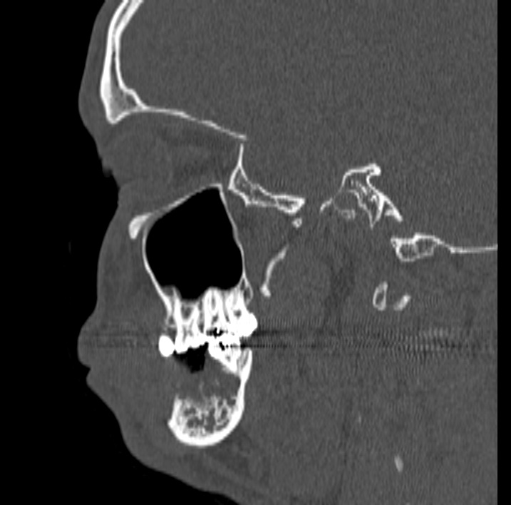 Ameloblastoma (Radiopaedia 77750-89997 Sagittal bone window 45).jpg