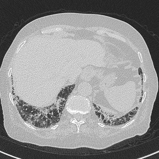 Amiodarone-induced pulmonary fibrosis (Radiopaedia 82355-96460 Axial lung window 59).jpg