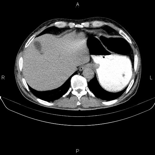 File:Ampullary adenocarcinoma (Radiopaedia 86093-102032 Axial C+ delayed 14).jpg