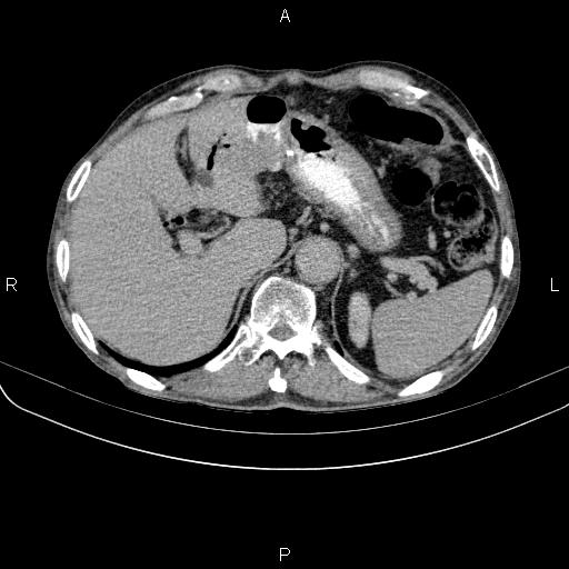 Ampullary adenocarcinoma (Radiopaedia 86093-102033 Axial C+ delayed 26).jpg