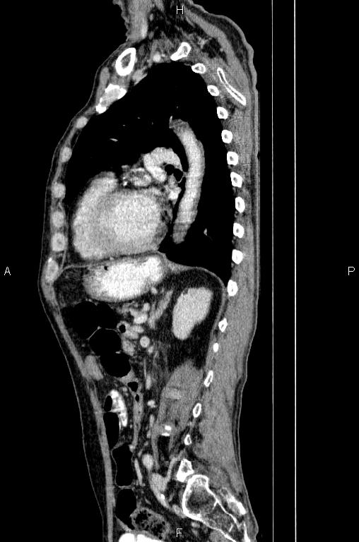 Ampullary adenocarcinoma (Radiopaedia 86093-102033 E 60).jpg
