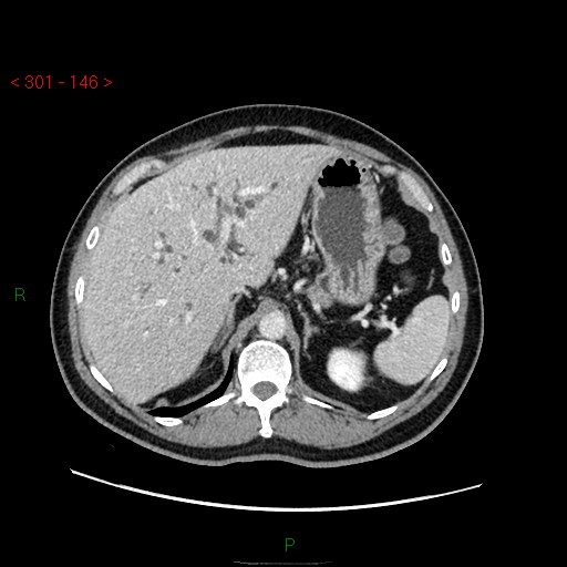 Ampullary carcinoma (Radiopaedia 56396-63056 C 25).jpg
