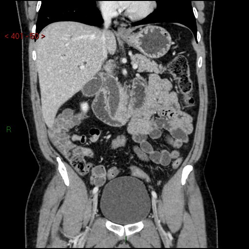Ampullary carcinoma (Radiopaedia 56396-63056 E 49).jpg