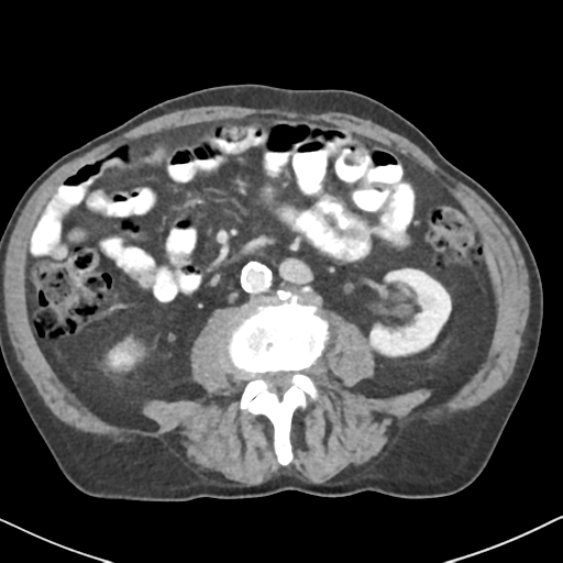 File:Amyand hernia (Radiopaedia 39300-41547 A 35).png