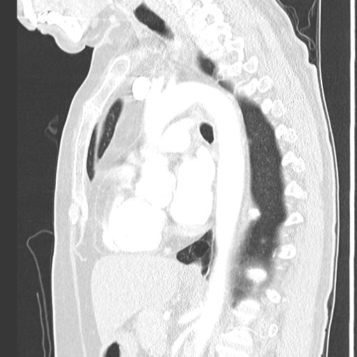 File:Amyloidosis - bronchial and diffuse nodular pulmonary involvement (Radiopaedia 60156-67745 Sagittal lung window 50).jpg
