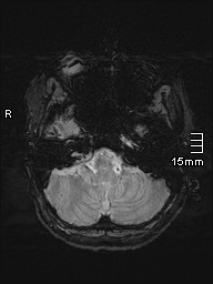 File:Amyotrophic lateral sclerosis (Radiopaedia 70821-81017 Axial SWI 4).jpg