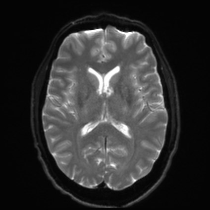 Amyotrophic lateral sclerosis (Radiopaedia 87352-103658 Axial DWI 15).jpg