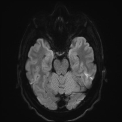 File:Amyotrophic lateral sclerosis (Radiopaedia 87352-103658 Axial DWI 37).jpg