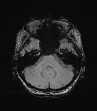 File:Anaplastic astrocytoma (Radiopaedia 86943-103160 Axial SWI 25).png