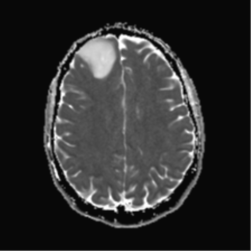 File:Anaplastic astrocytoma IDH mutant (Radiopaedia 50046-55341 Axial ADC 19).png
