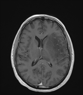 Anaplastic astrocytoma IDH wild-type (Radiopaedia 49984-55273 Axial T1 C+ 33).png