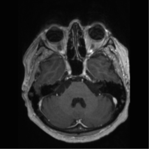 File:Anaplastic astrocytoma IDH wild-type (pseudoprogression) (Radiopaedia 42209-45277 Axial T1 C+ 31).png