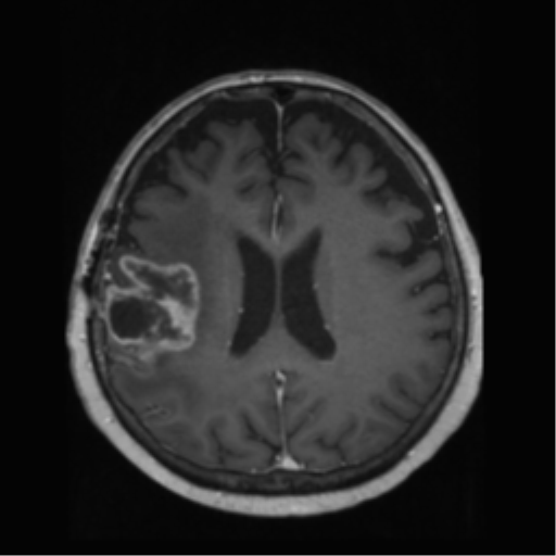File:Anaplastic astrocytoma IDH wild-type (pseudoprogression) (Radiopaedia 42209-45278 Axial T1 C+ 98).png