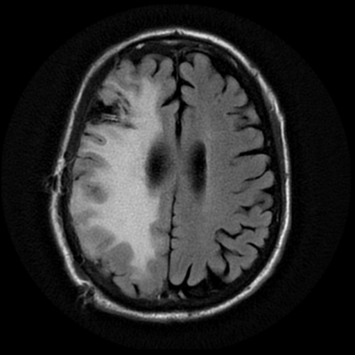 File:Anaplastic meningioma with recurrence (Radiopaedia 34452-35791 Axial FLAIR 15).png