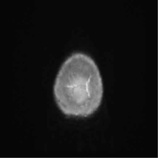 Anaplastic oligodendroglioma (Radiopaedia 83500-98599 Axial T1 C+ 78).png